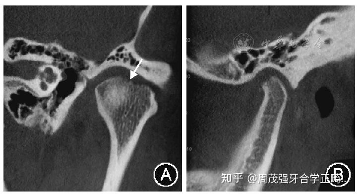 圖4顳下頜關節退行性關節病患者左側髁突錐形束ct影像,髁突頂外側骨