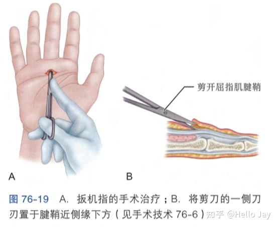 狭窄性腱鞘炎手术步骤图片