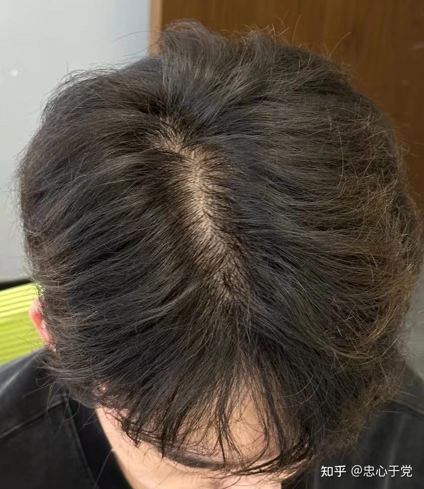 洗头发掉头发好多,有没有好用的男士防脱发洗发水?