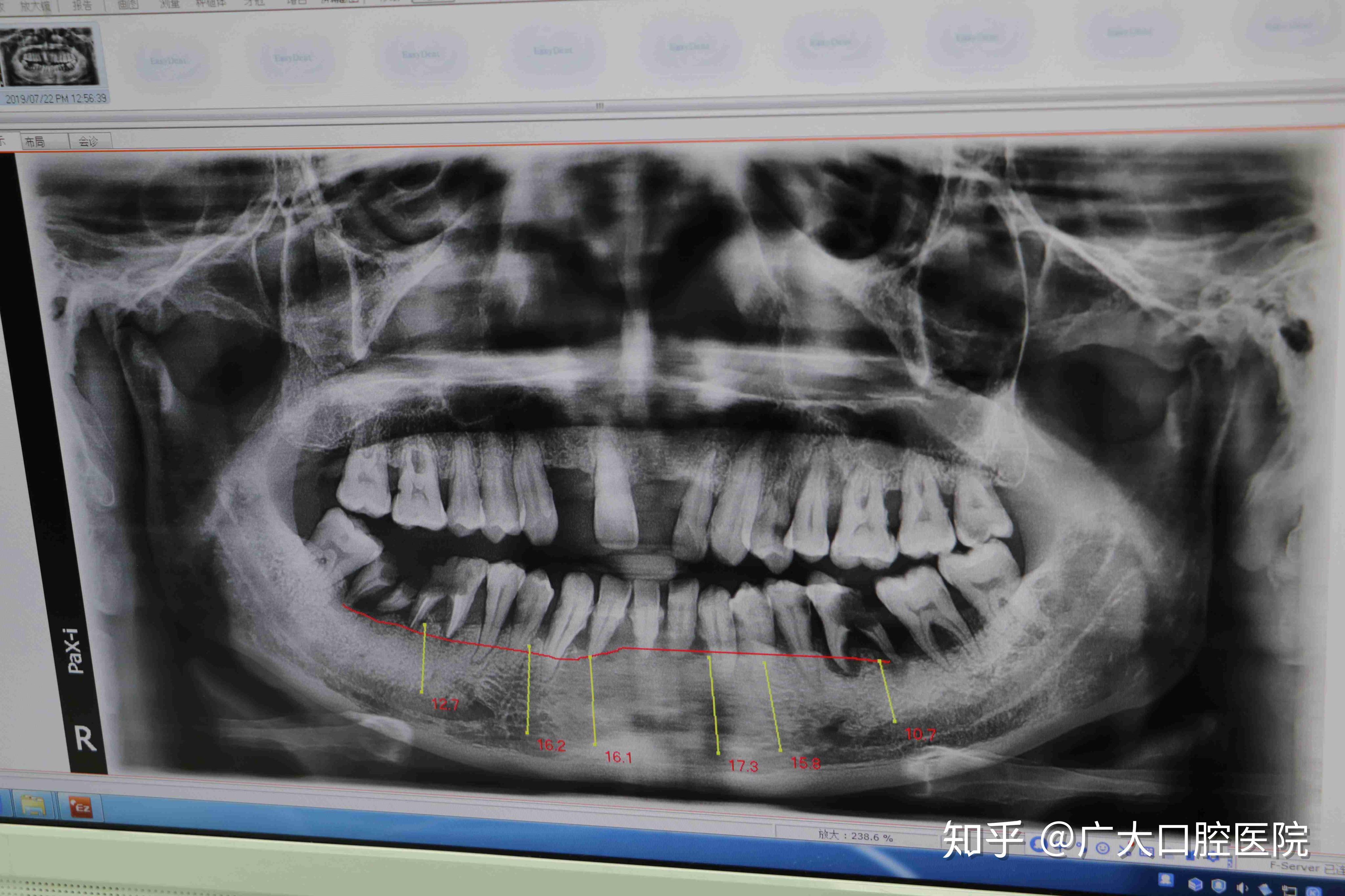 20岁的女生，矫正牙齿戴牙套，还要拔四颗牙是什么感觉啊，担心会不会有后遗症！？ - 知乎