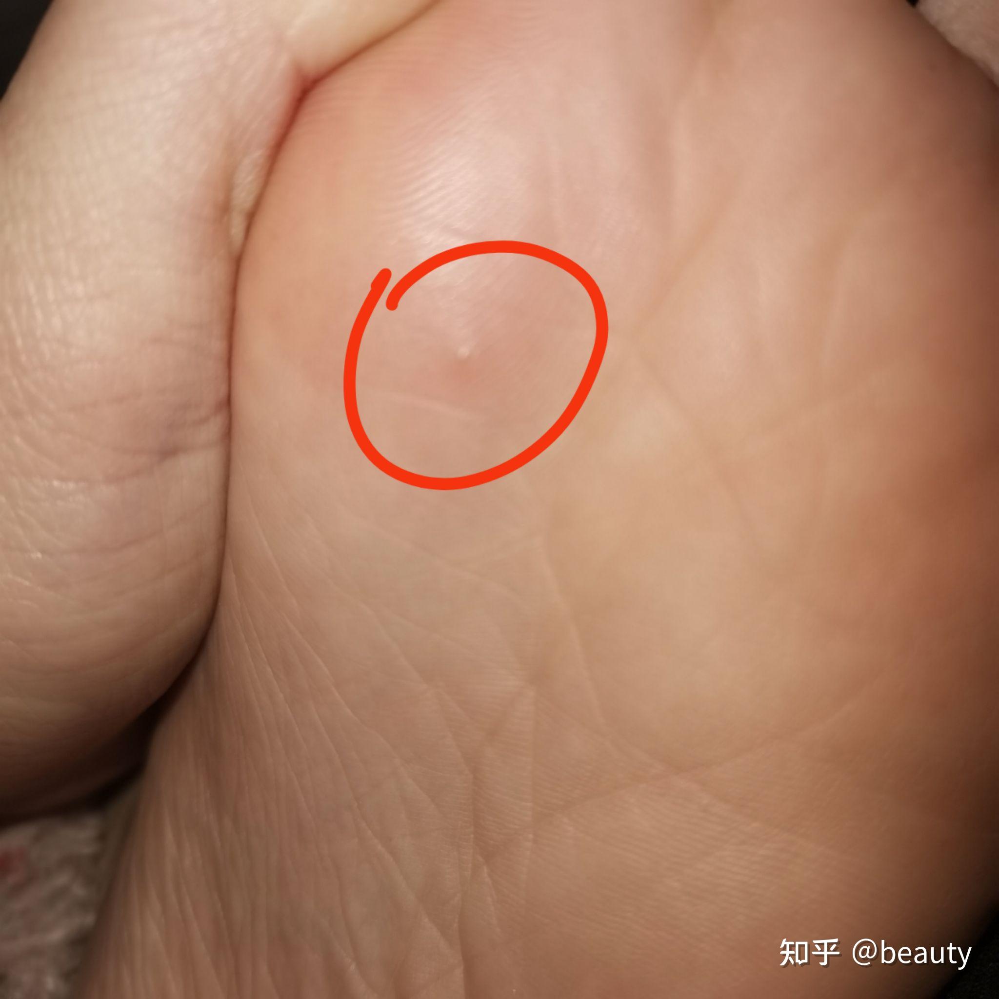 跖疣能自愈吗?心态真的很重要吗?有什么办法让它好?