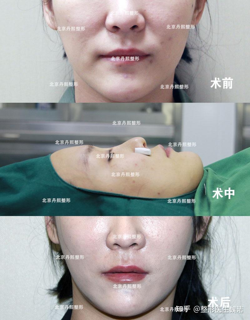 据我们多年的临床经验,膨体垫鼻基底手术没必要打钉,就手术本身来讲