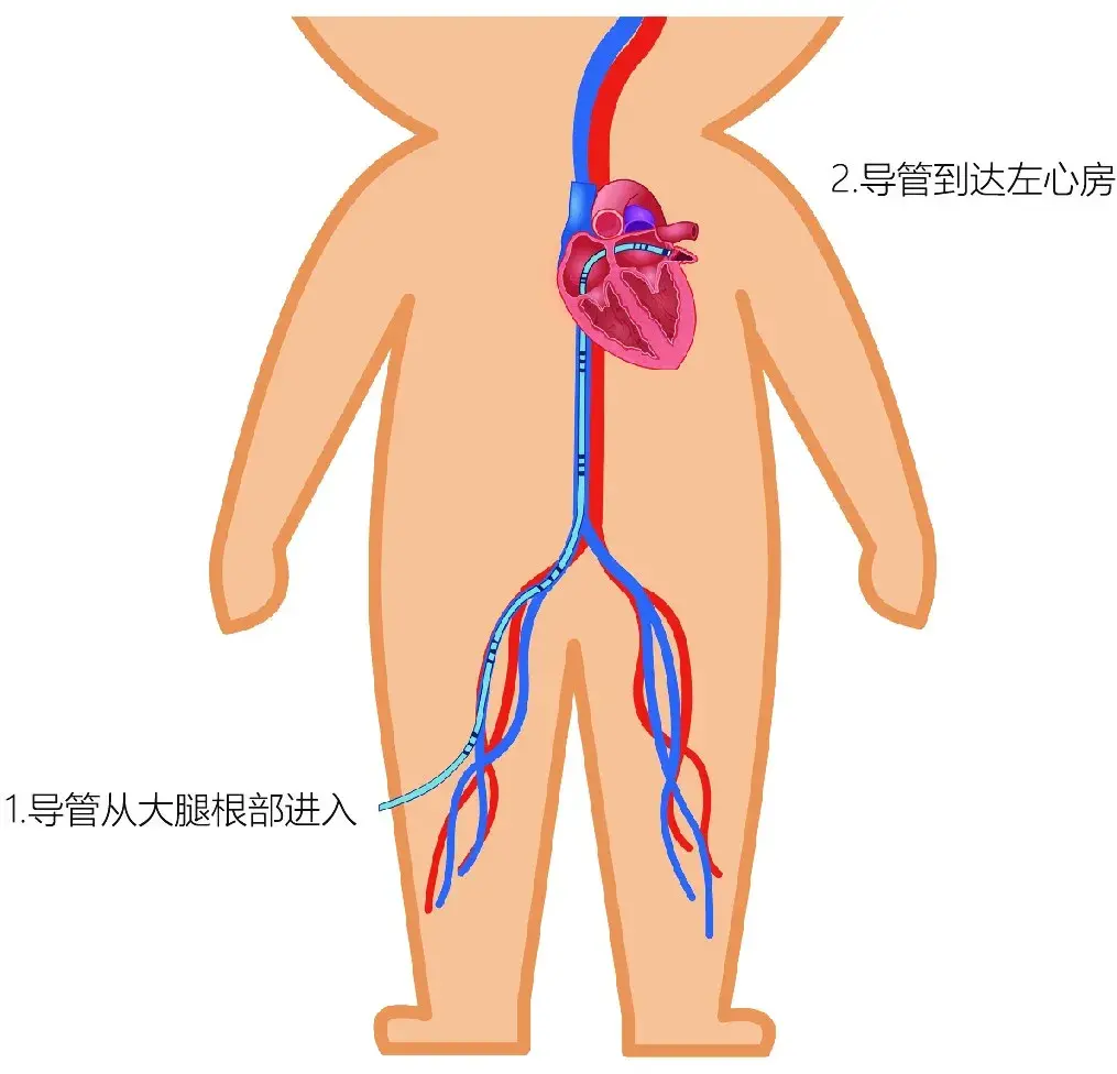 6.6中国房颤日 | 破解关于房颤的6个误区