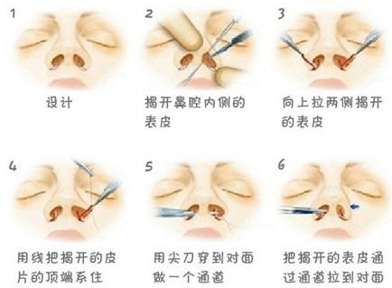 怎么缩小鼻翼缩鼻翼手术风险大吗