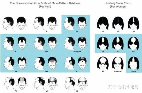 如何判断脱发几级了