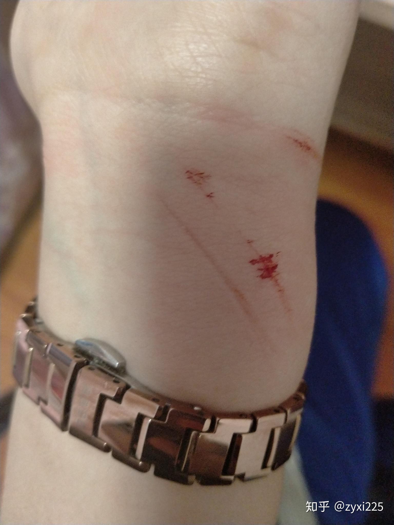 怎样拯救一个自残过的女生