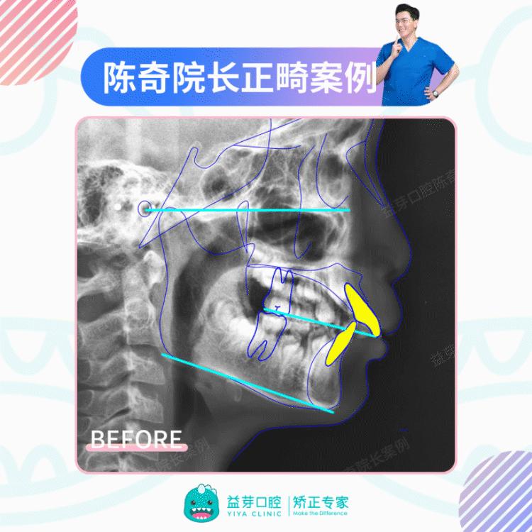 【超难度案例】严重嘴突+下巴后缩，11岁下颌前导生长解决Ⅲ度深覆盖，0拔牙0骨钉！ - 知乎