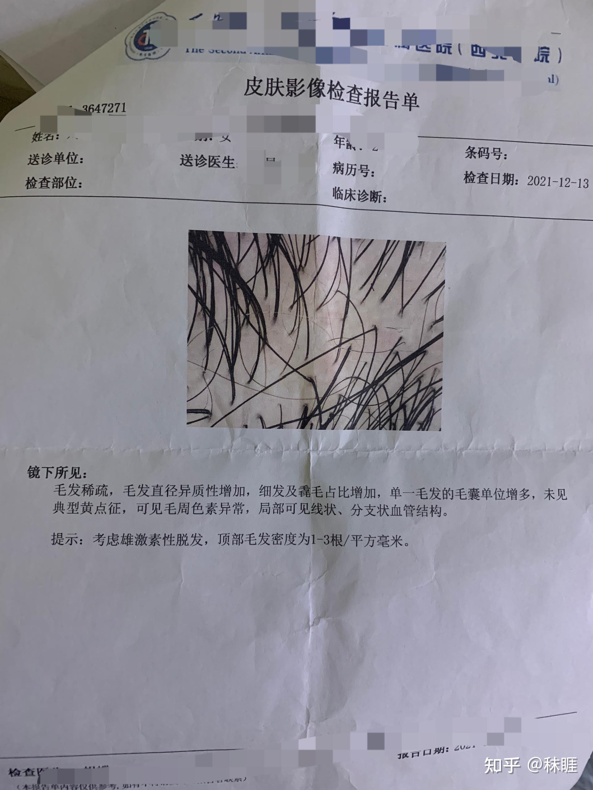 雄性激素型秃发治疗打卡第一天 - 知乎