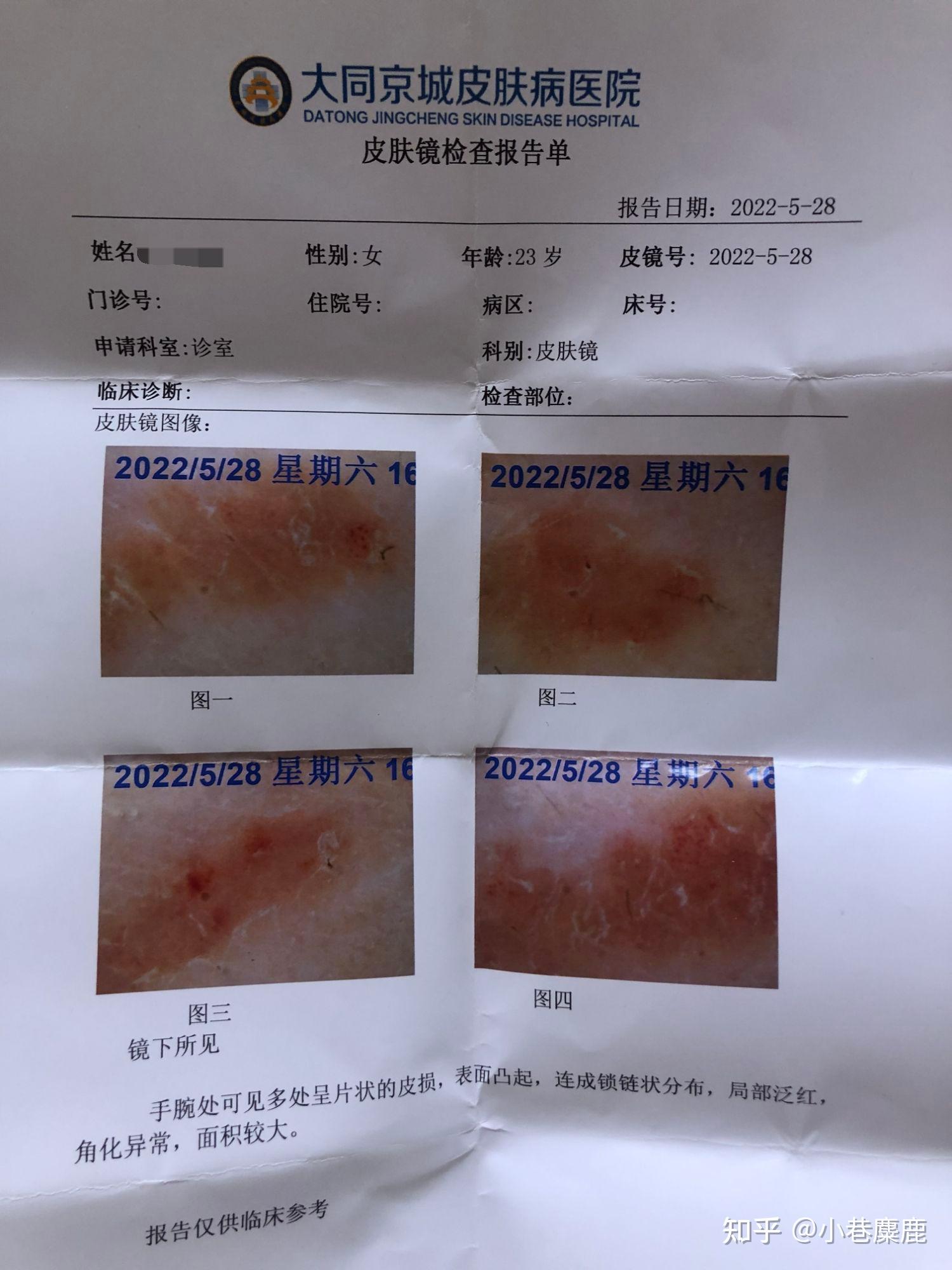 上网冲浪了一下,发现可能是"扁平疣",当下就去了大同京城皮肤病医院