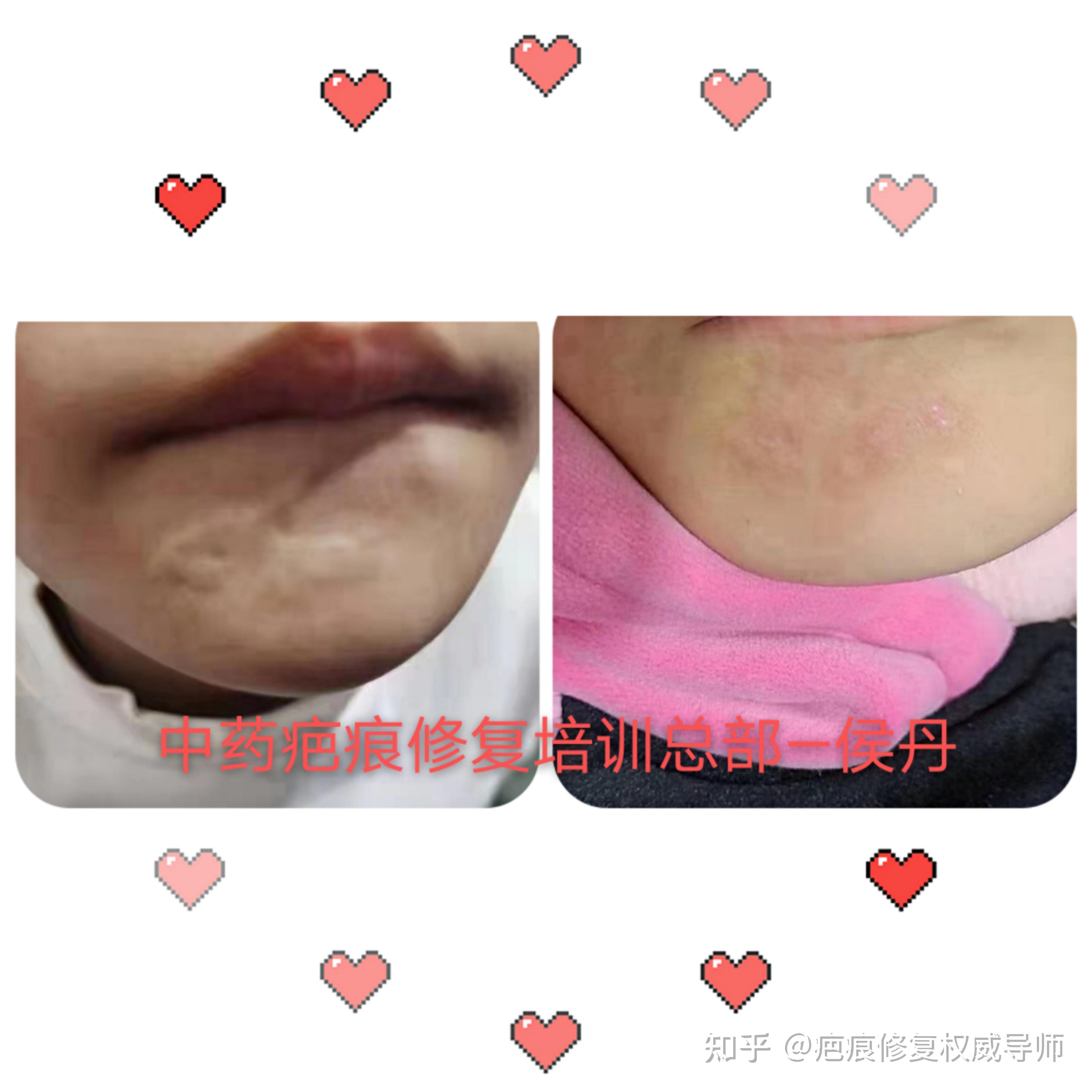 α姐姐说疤痕—正确认识疤痕的形成 - 知乎