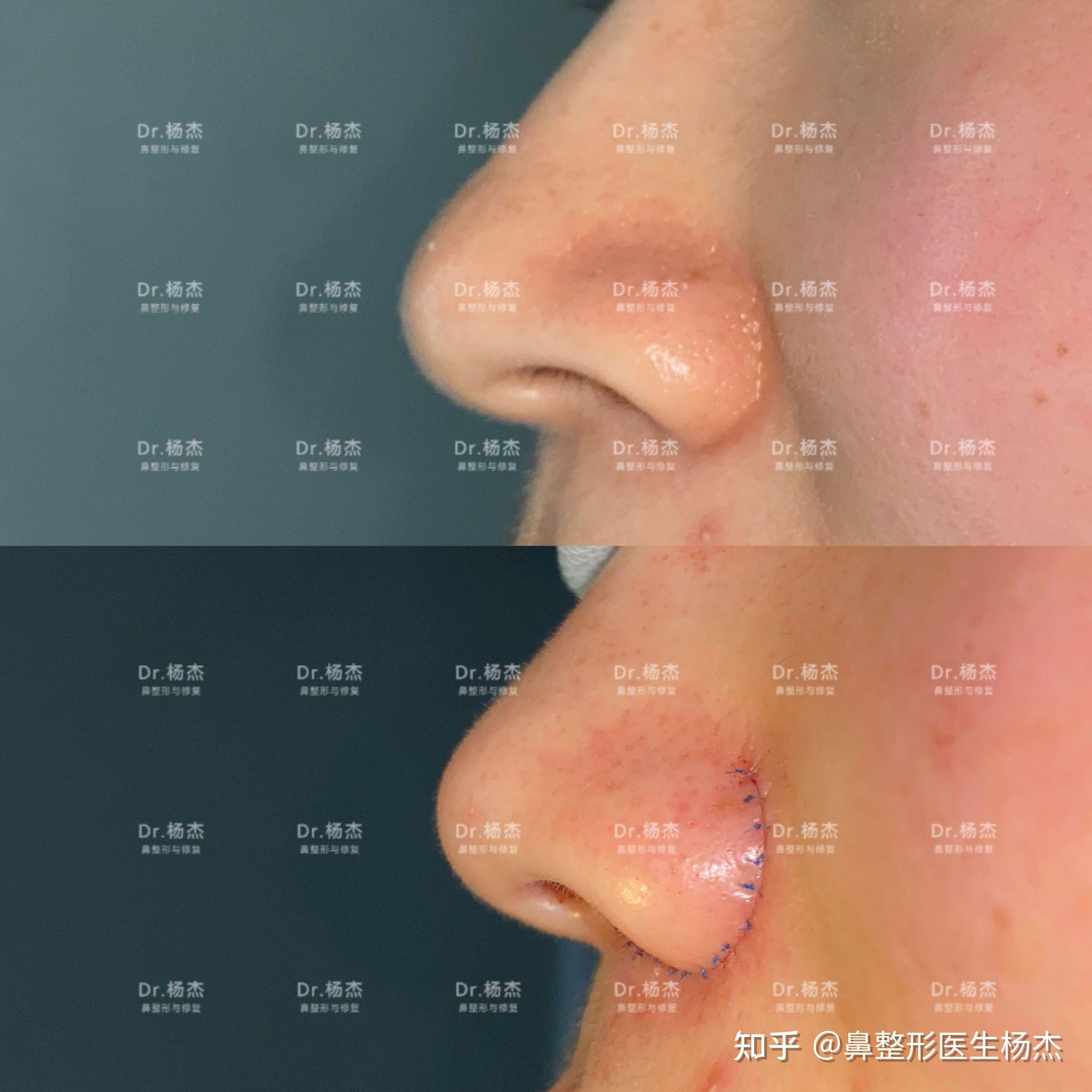 4尽量调整两侧鼻孔和鼻翼对称性,伤口精细缝合3