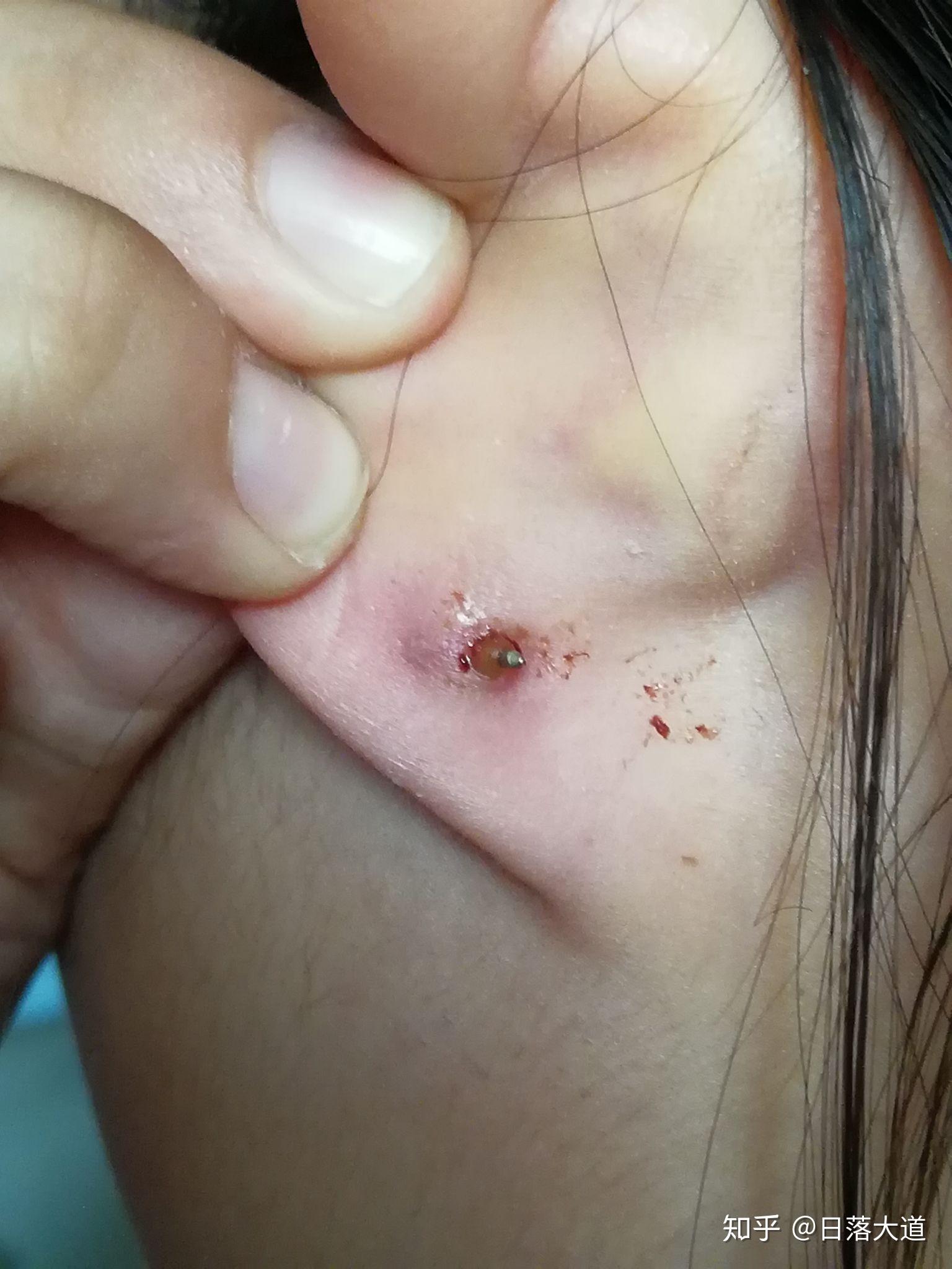 耳堵陷在耳洞里了怎么办