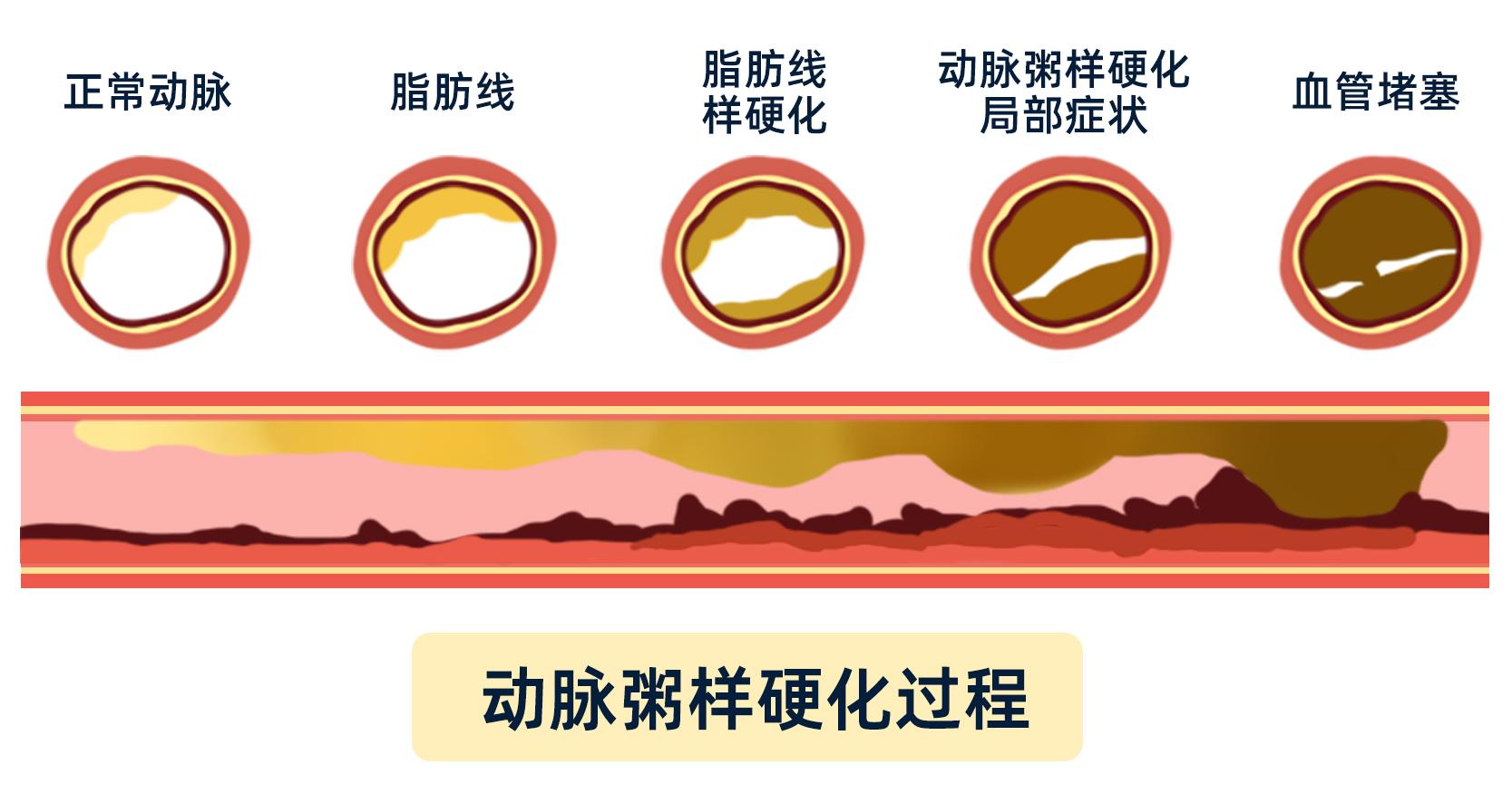 你的血管弹性怎样,一个小动作就能测出?4个方法,缓动脉硬化 - 知乎