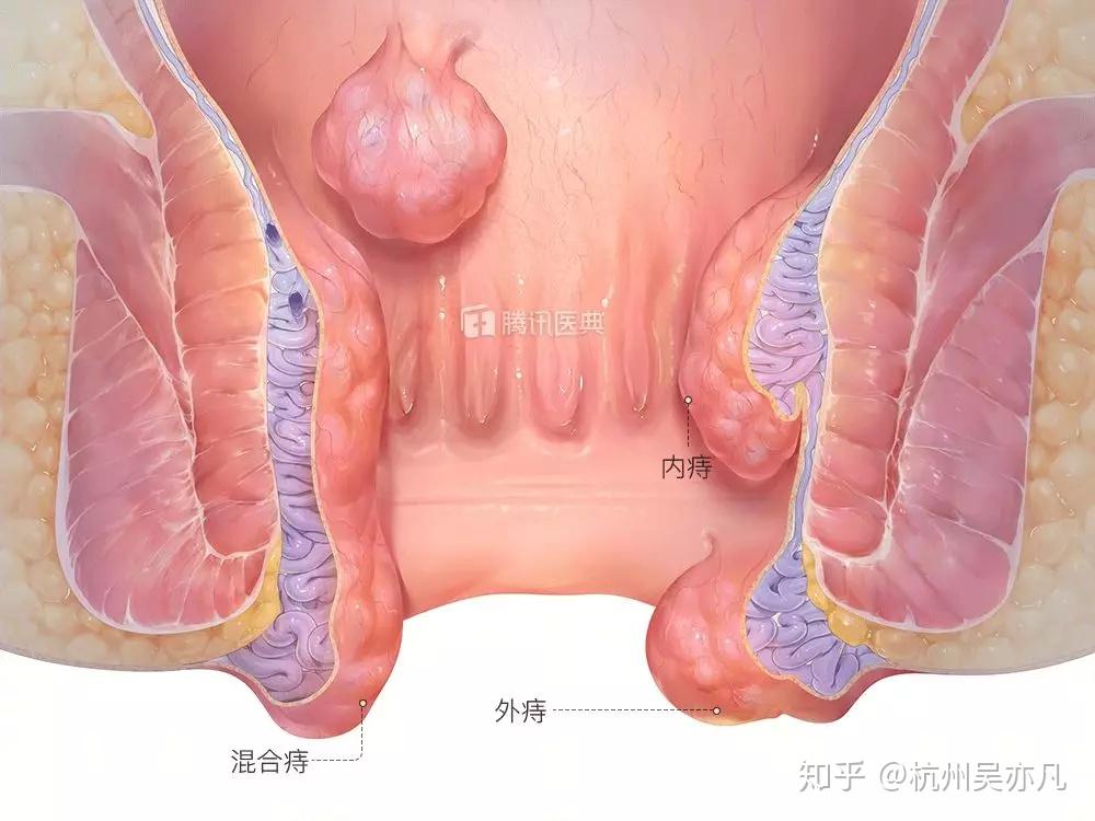 轻微痔疮轻度图片