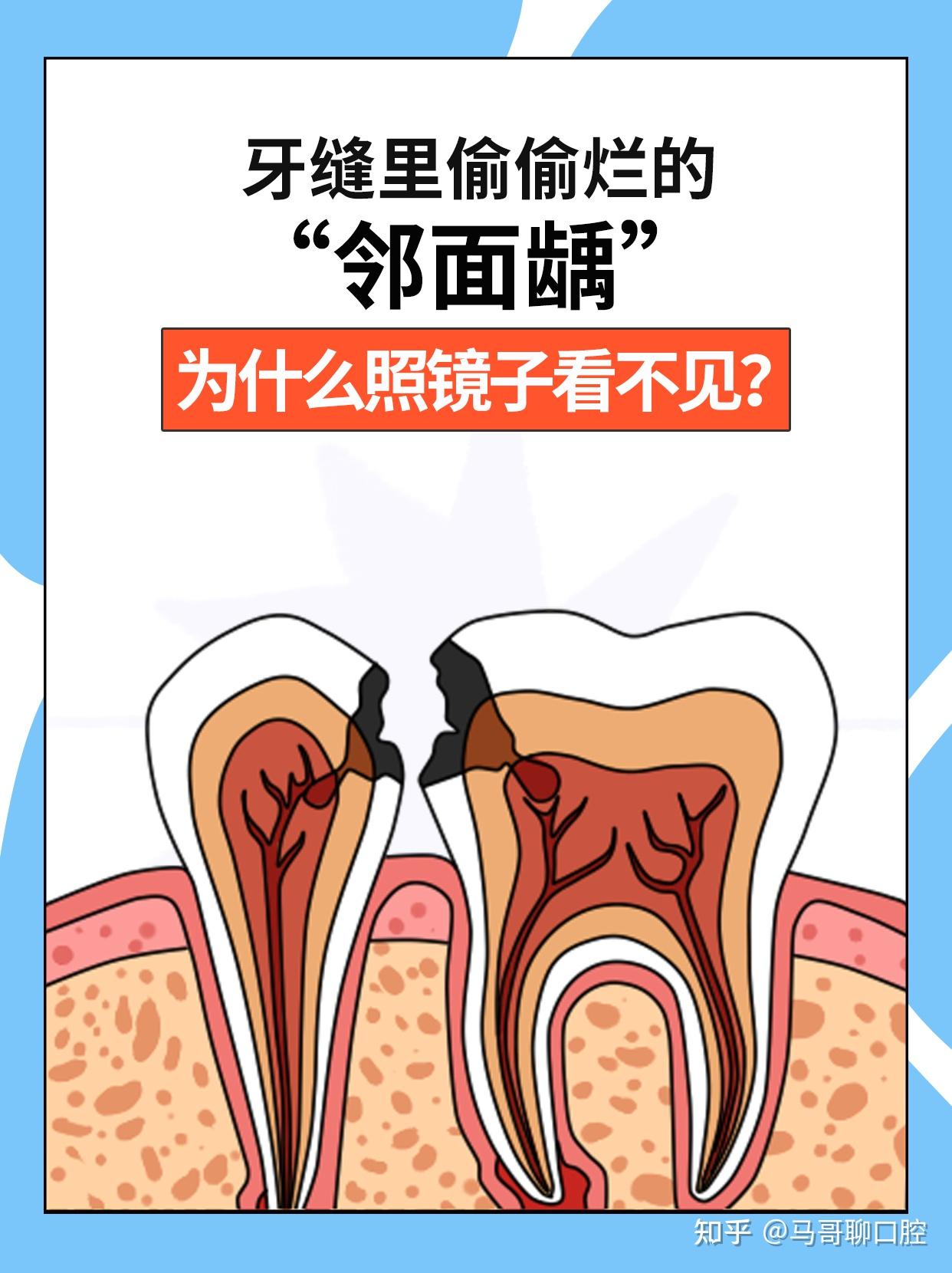 牙缝里偷偷烂的“邻面龋” - 知乎