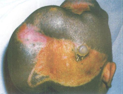 扩张带毛头皮瓣修复烧伤后头皮脱发