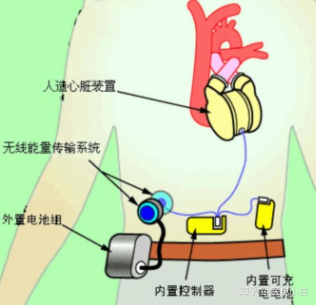 假如心脏永久停止工作怎么办