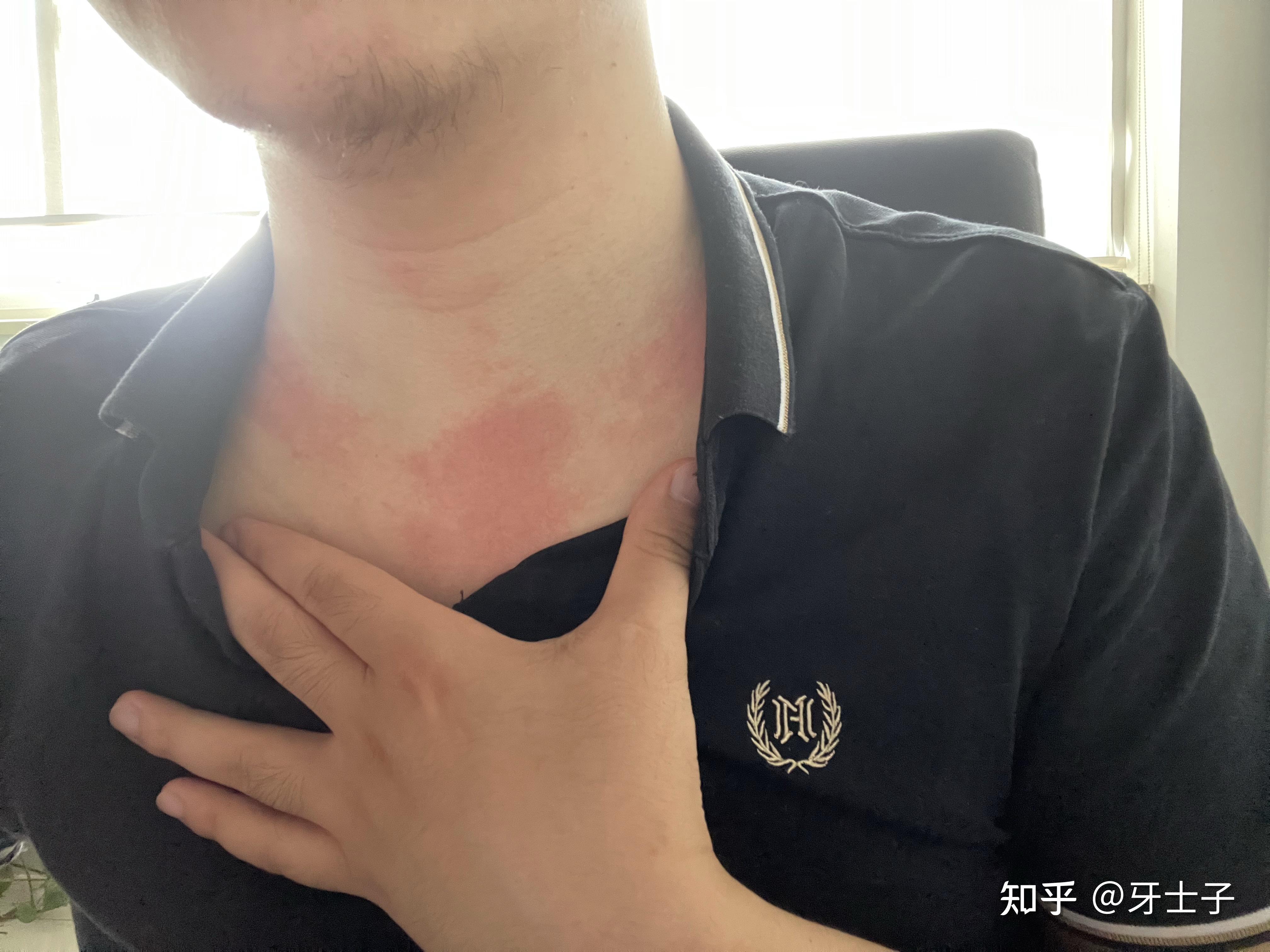 打科兴新冠疫苗后身体过敏反馈全记录(更新)