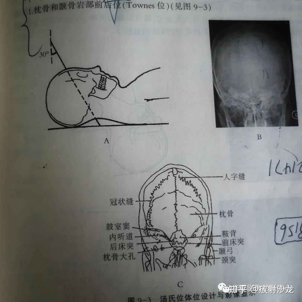 颧弓位片图片