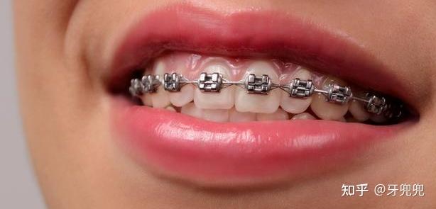 隐形牙套好看又方便为什么医生不建议用内行人告诉你原因
