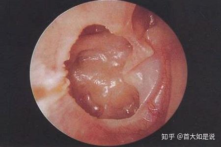 首大戴海江分泌性中耳炎的典型症状都有哪些