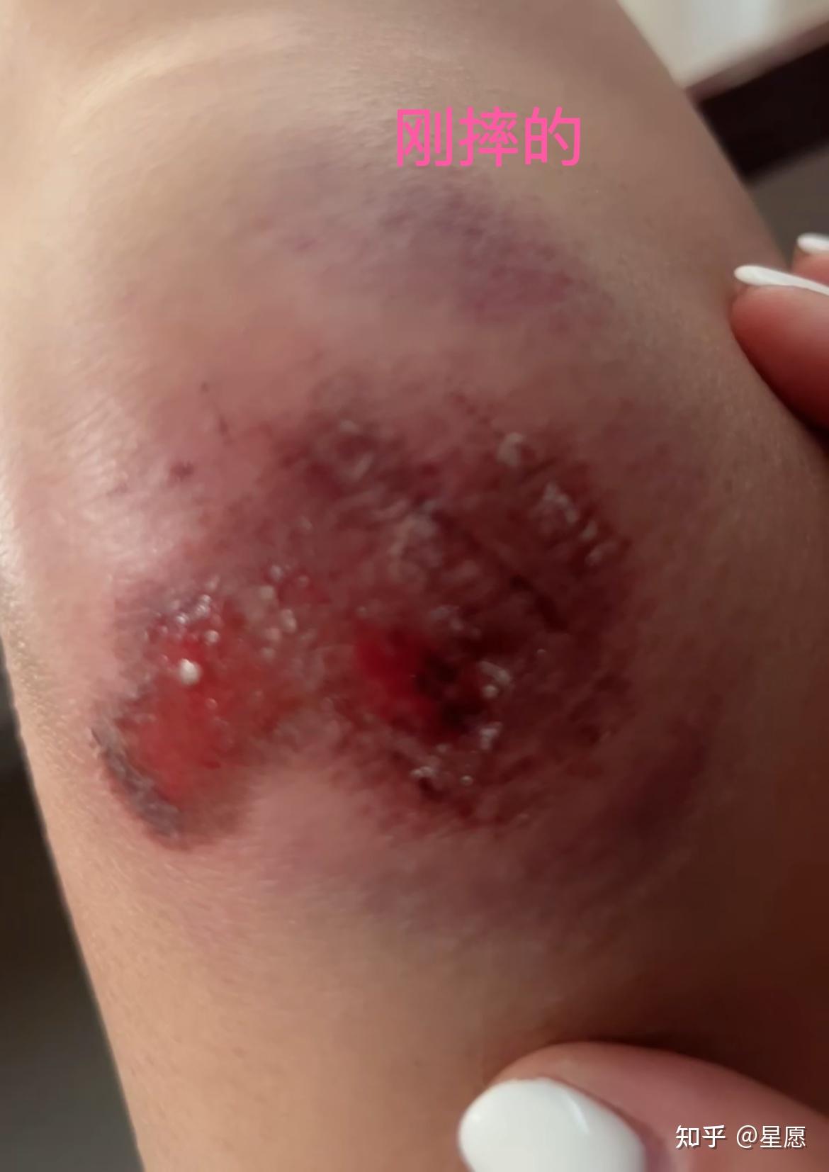 左侧胳膊肘,双膝关节不同程度擦伤 最严重的就是左侧膝盖本来没当回事