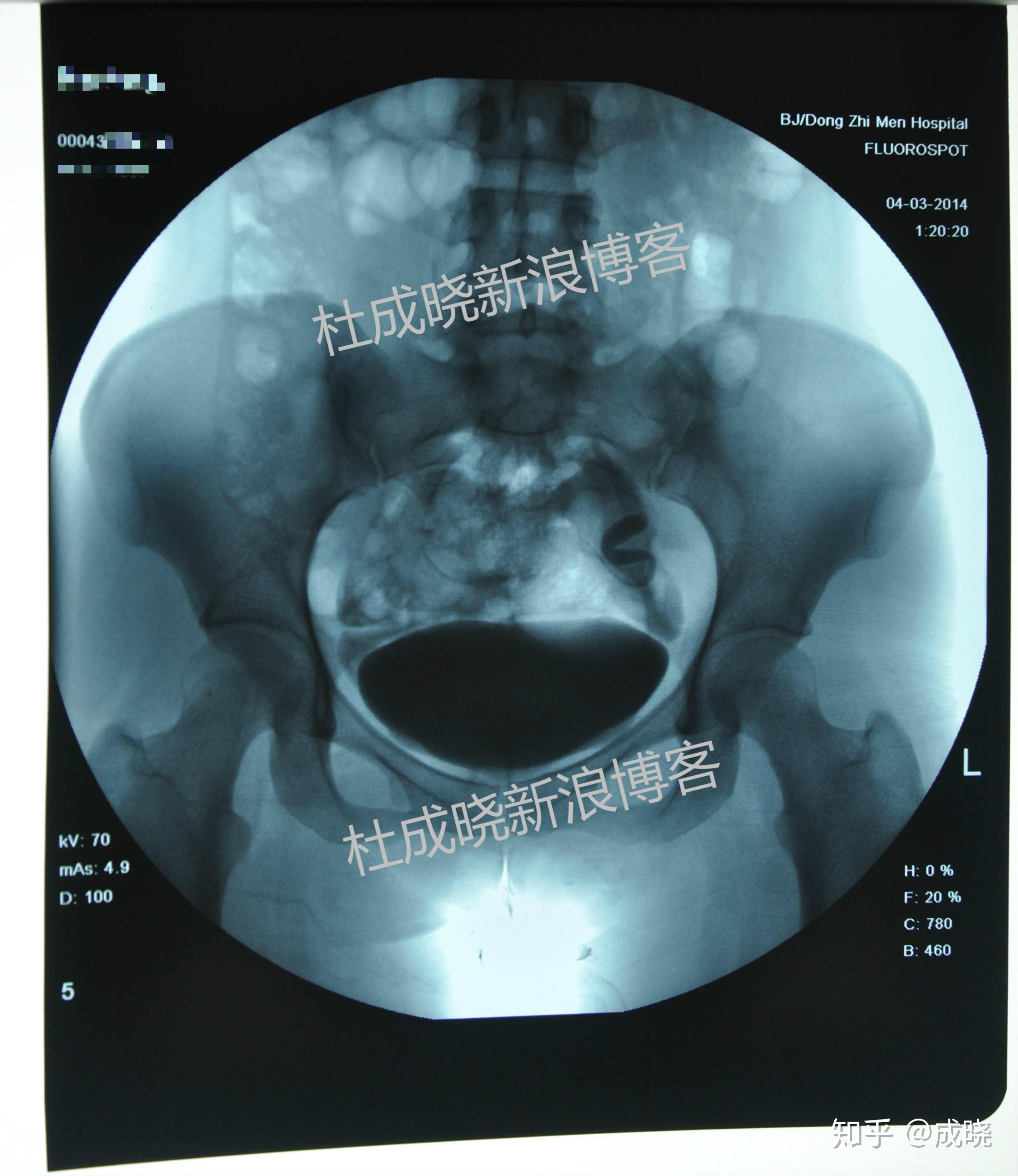 弥散不均匀(提示有盆腔粘连)第1,2张片子,是看打入造影剂后子宫输卵管