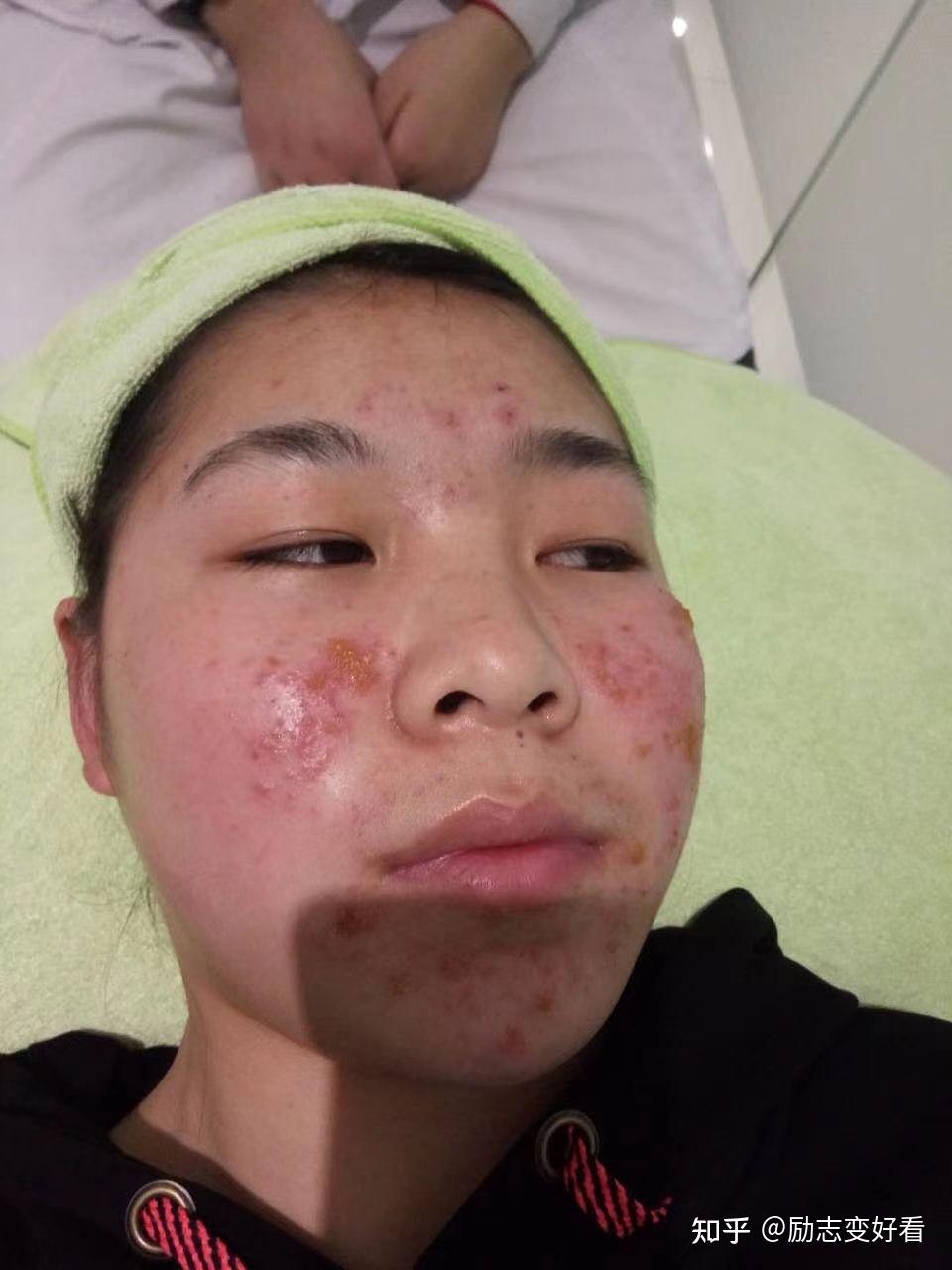 激素脸 - 知乎