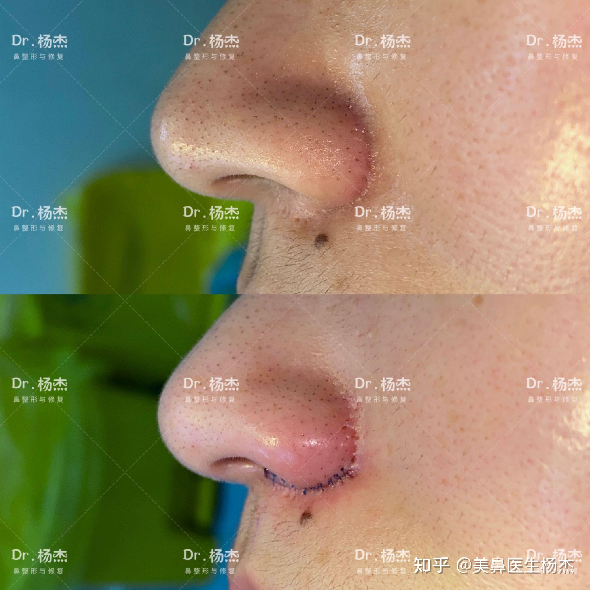 鼻翼内切缩小