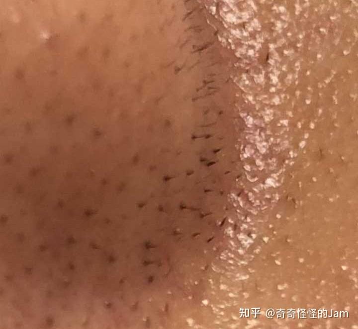 如何区别你的黑头