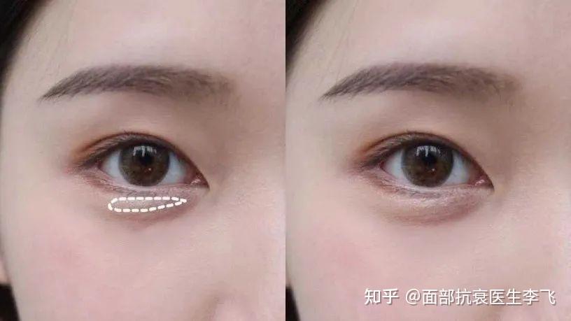 李飞抗衰关于注射玻尿酸丰卧蚕效果怎么样子呢