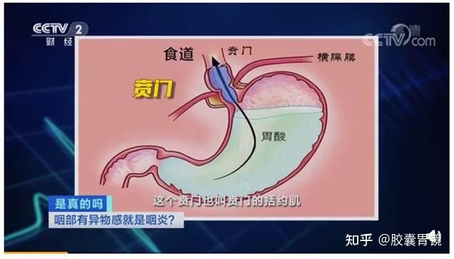 正常情況下,人體吞嚥食物後會經過食道進入胃部,而賁門括約肌就在食道