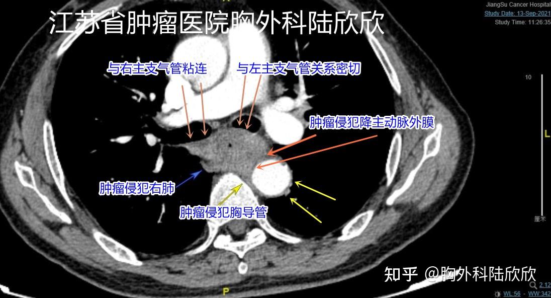 一例巨大食管癌侵犯周围器官患者的住院经过 - 知乎