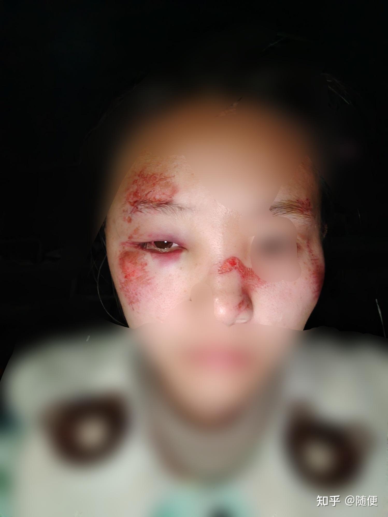 女大学生骑电动车摔伤经历记录