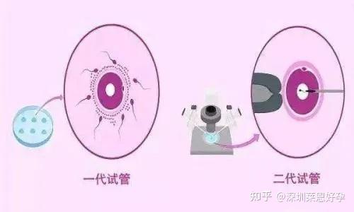 试管婴儿一代二代三代,在方式上有什么区别 - 知乎