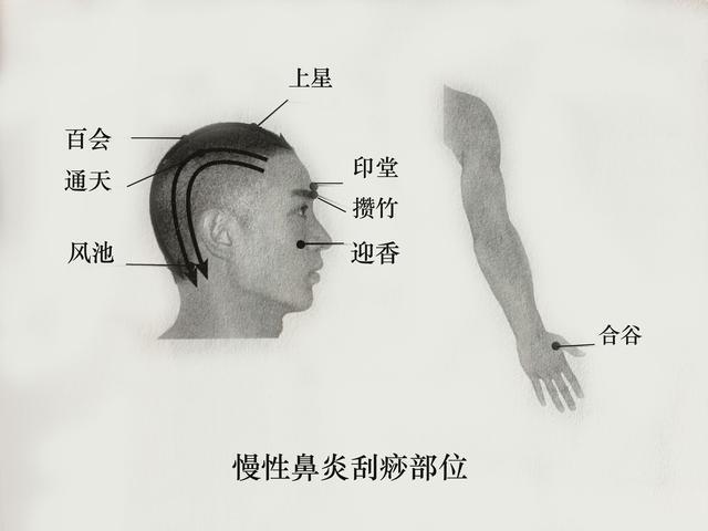 鼻塞刮痧的方法示意图图片