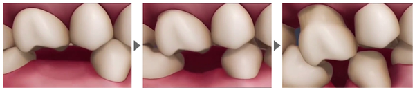 牙齿缺失有什么危害？