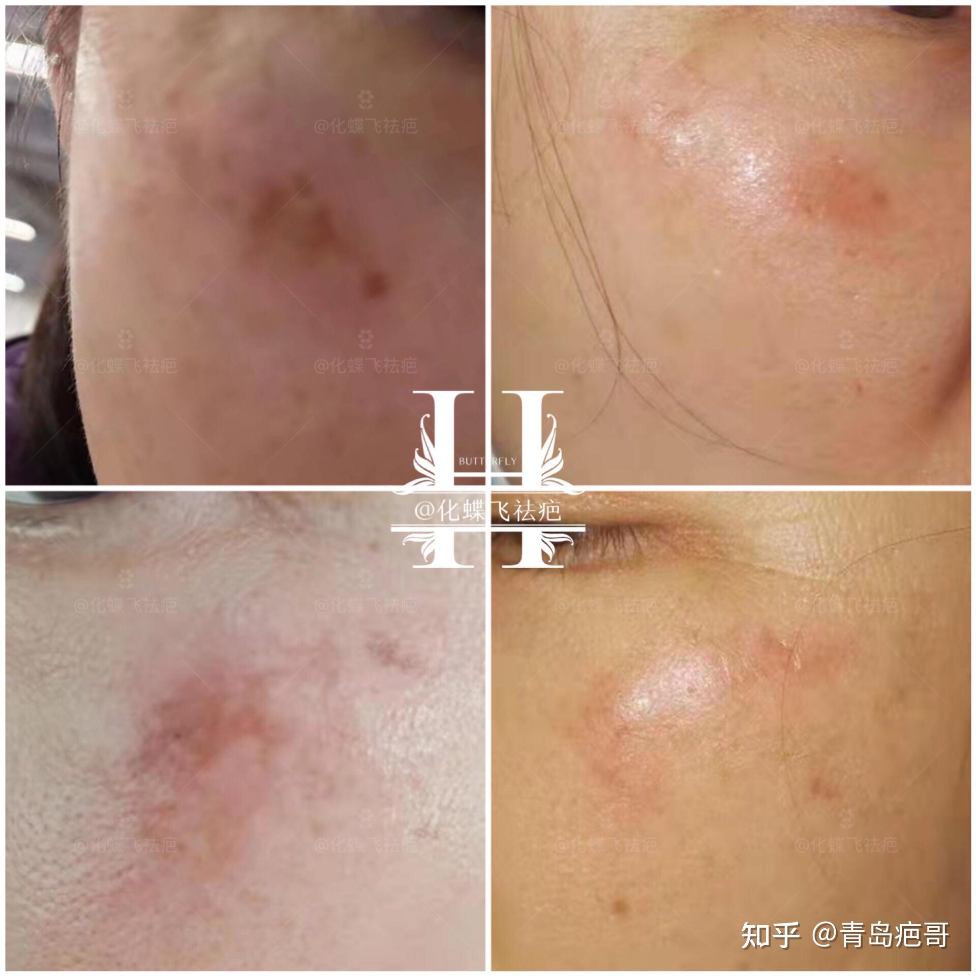 激光后色素回流淡化