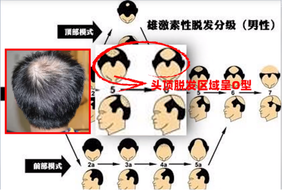 头发整体稀疏,头顶脱发区域呈现o型1