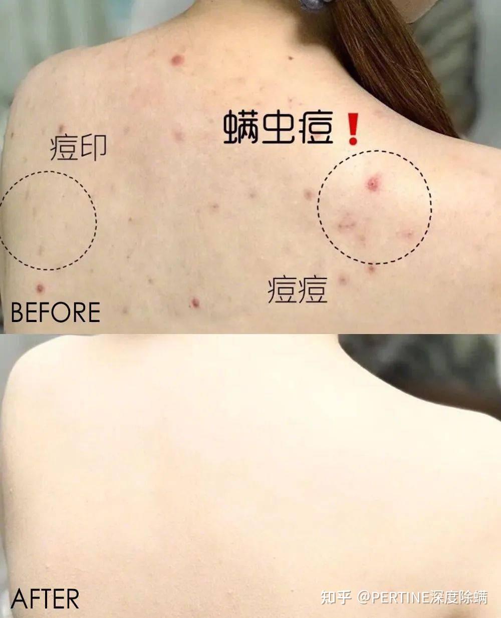 pertine珀婷植萃深度除螨喷雾中的天然草本成分对螨虫有抑制分解作用