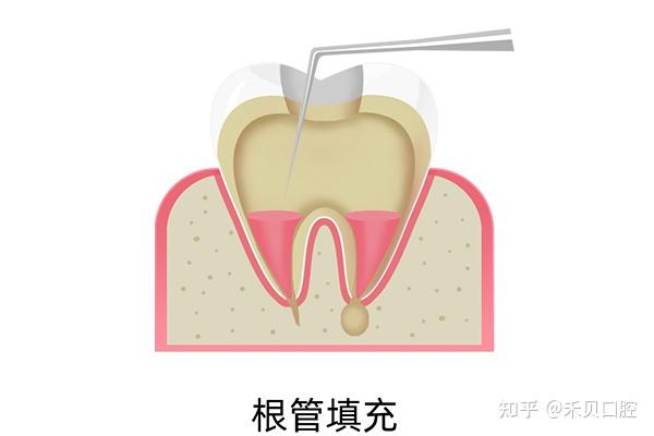根尖诱导成形术是什么? - 知乎