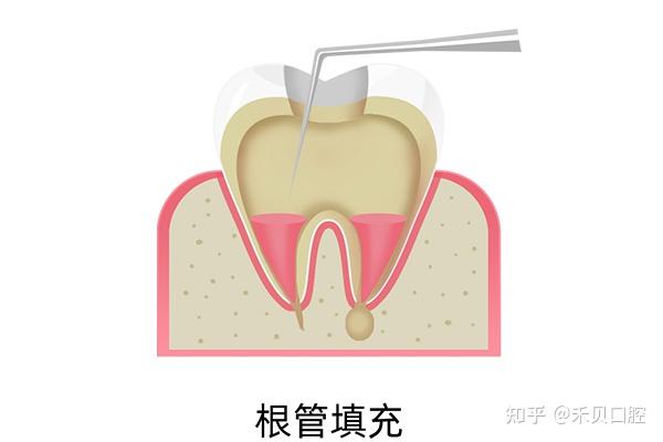 根尖诱导成形术步骤图片