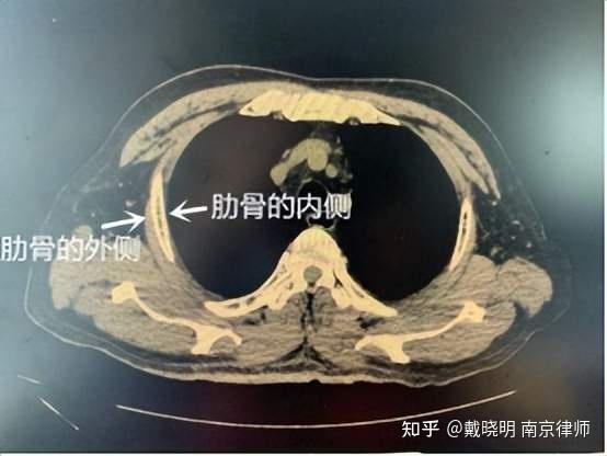 肋骨骨质破坏图片