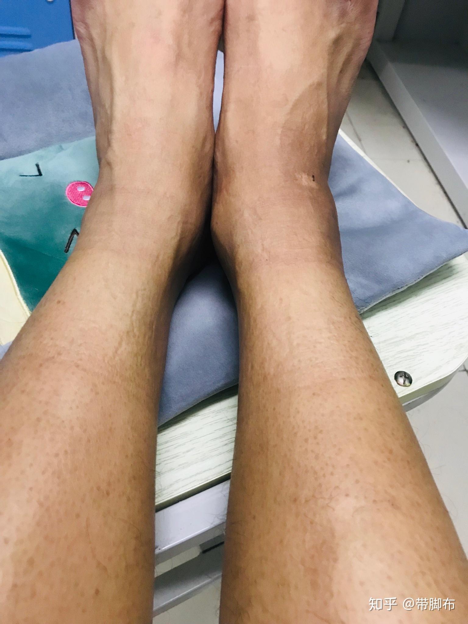 脚歪了四个多月了,还没好,脚踝还肿着,真害怕以后不能打球了