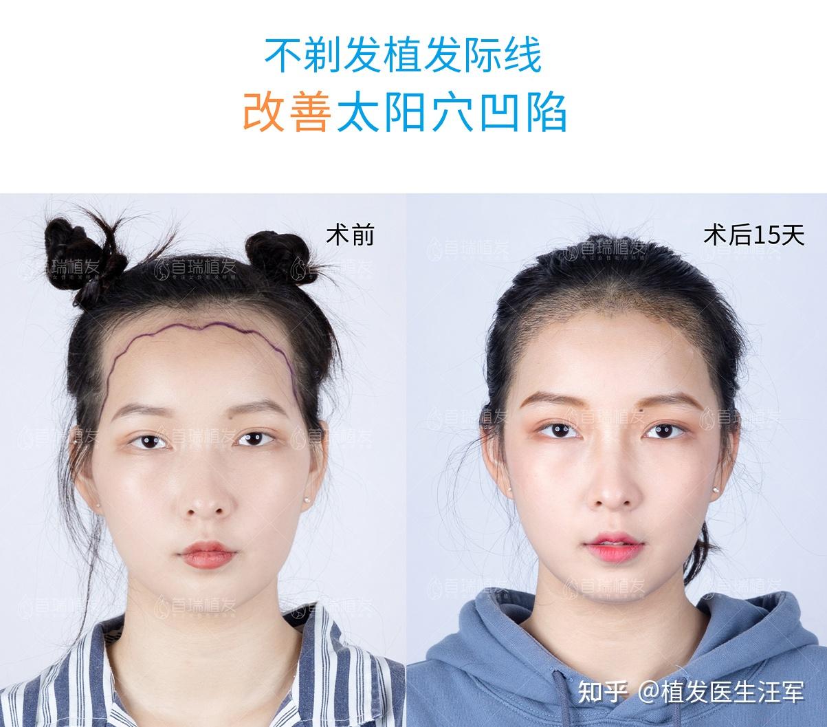 植发价格：揭秘行业的透明真相