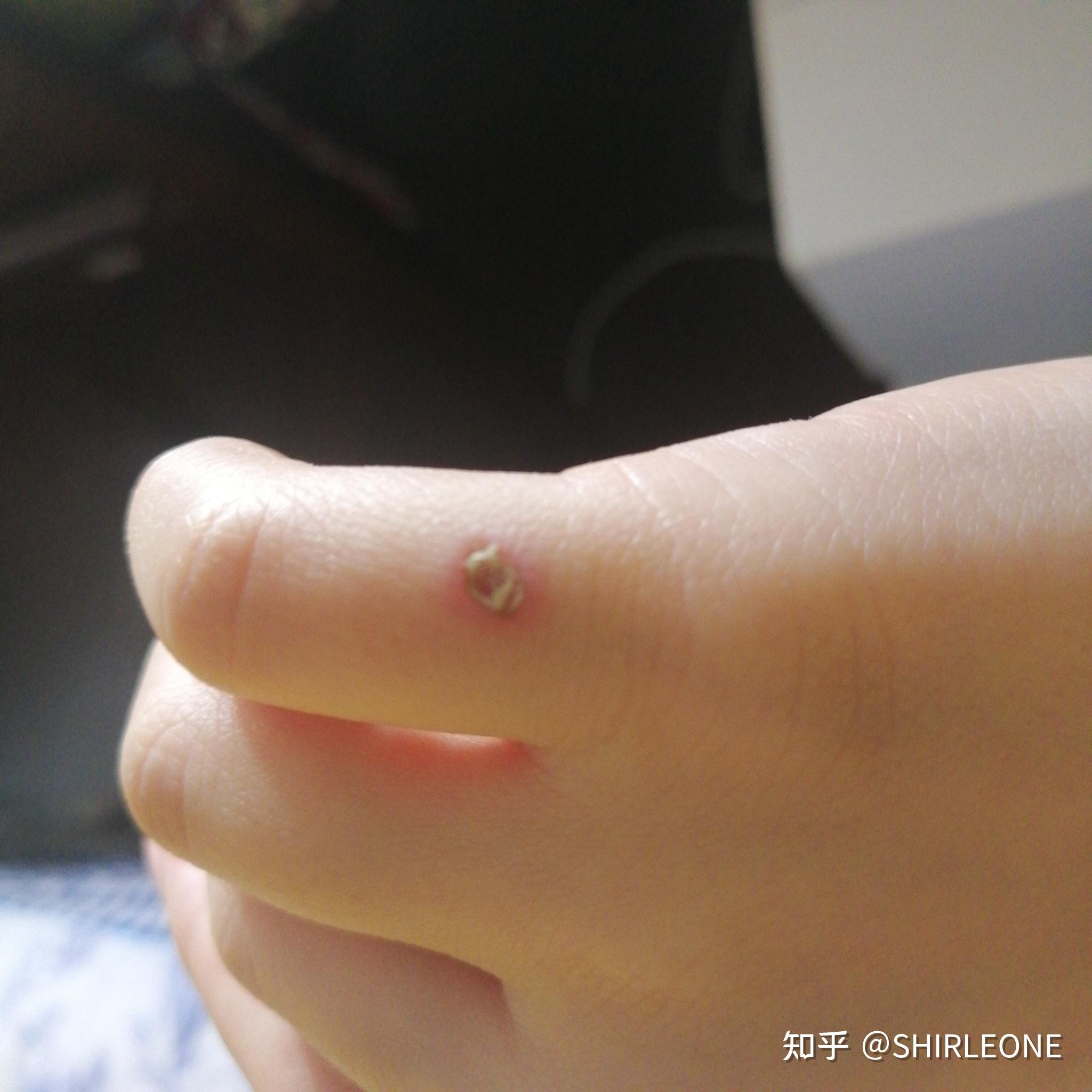 点痣,发炎了怎么办 - 知乎