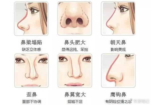 隆鼻手术如何找到技术好靠谱的医生