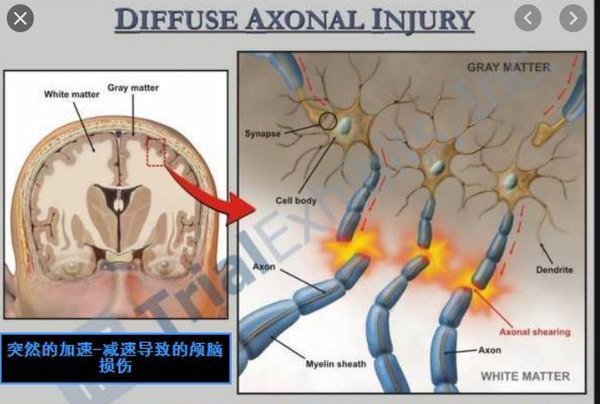轴突损伤图片