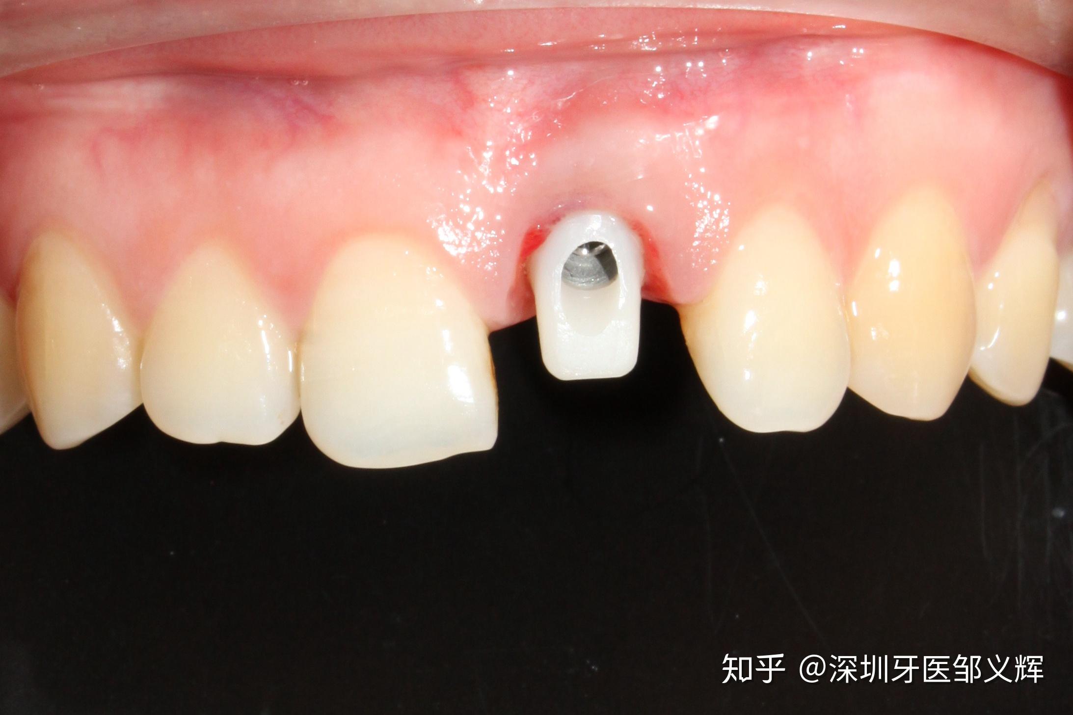 门牙外伤折断即拔即种即刻修复一例