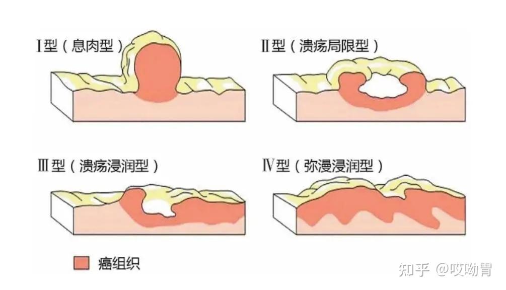 病理报告=有字天书？别急，一文教你看懂胃癌病理报告 - 知乎